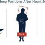 Best Sleeping Positions after Open Heart Surgery